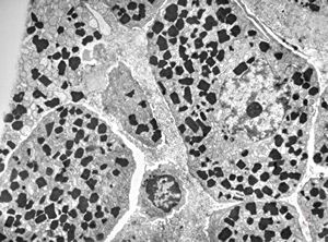 M,47y. | plasmocytoma - nasopharynx M,47y. | plasmocytoma - nasopharynx